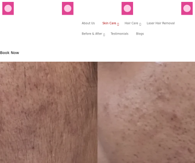 Chemical Peel Treatment