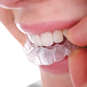 Affordable invisible braces sydney